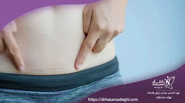 ابدومینوپلاستی-همزمان-با-سزارین